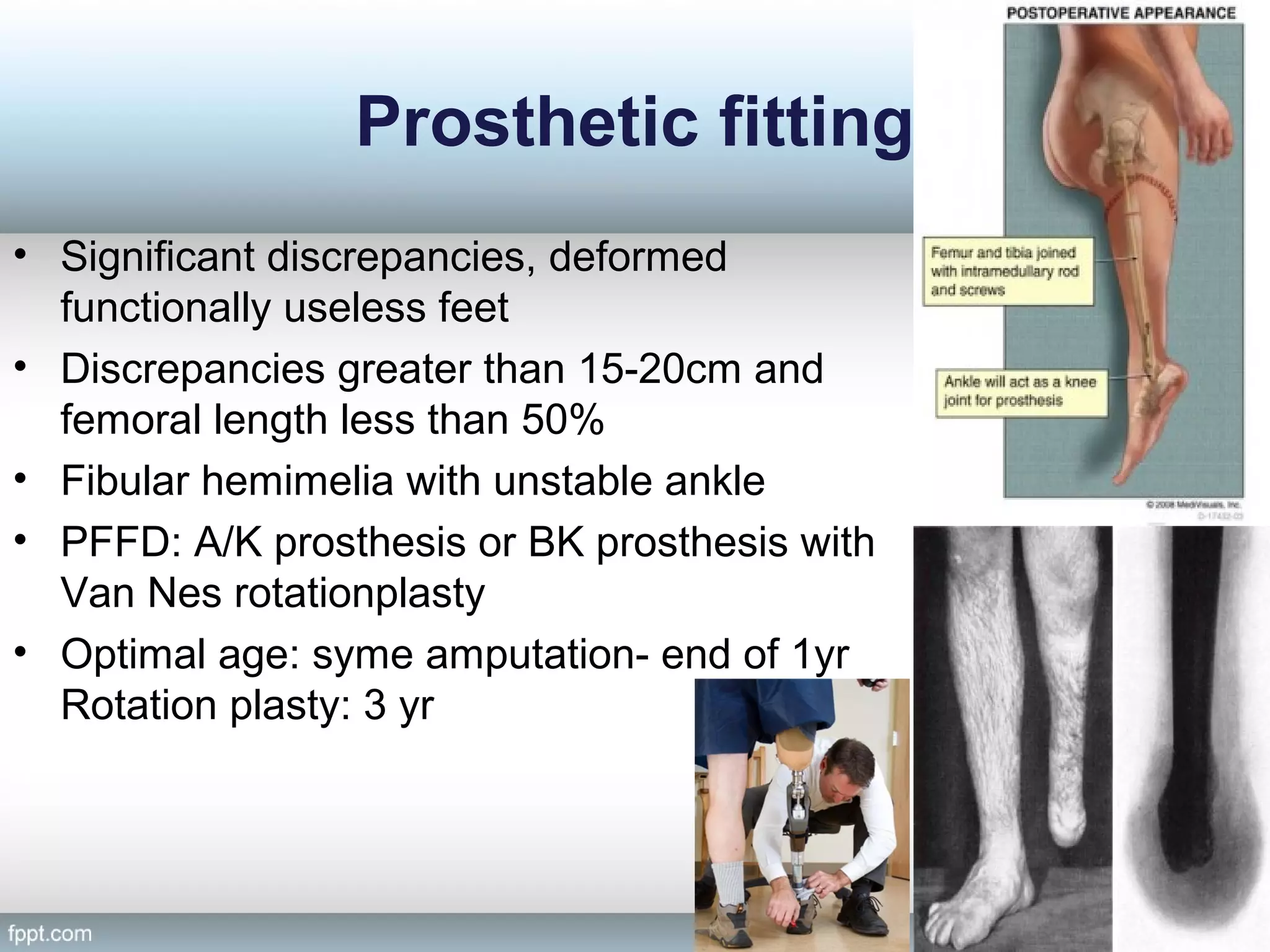 Limb length discrepency | PPT