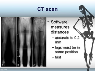 CT scan
• Software
measures
distances
– accurate to 0.2
mm
– legs must be in
same position
– fast
 