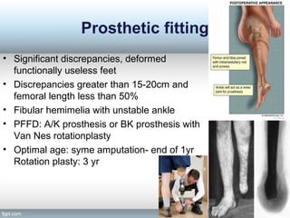 Prosthetic fitting
• Significant discrepancies, deformed
functionally useless feet
• Discrepancies greater than 15-20cm and
femoral length less than 50%
• Fibular hemimelia with unstable ankle
• PFFD: A/K prosthesis or BK prosthesis with
Van Nes rotationplasty
• Optimal age: syme amputation- end of 1yr
Rotation plasty: 3 yr
 