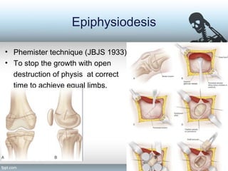 Epiphysiodesis
• Phemister technique (JBJS 1933)
• To stop the growth with open
destruction of physis at correct
time to achieve equal limbs.
 