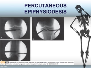PERCUTANEOUS
EPIPHYSIODESIS
 