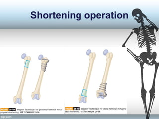 Shortening operation
 