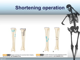 Shortening operation
 