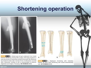 Shortening operation
 