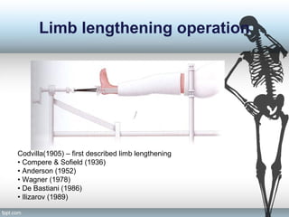 Limb lengthening operation
Codvilla(1905) – first described limb lengthening
• Compere & Sofield (1936)
• Anderson (1952)
• Wagner (1978)
• De Bastiani (1986)
• Ilizarov (1989)
 