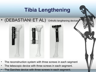 Tibia Lengthening
• (DEBASTIANI ET AL) Orthofix lengthening devices
• The reconstruction system with three screws in each segment
• The telescopic device with three screws in each segment.
• The Garches device with three screws in each segment.
 