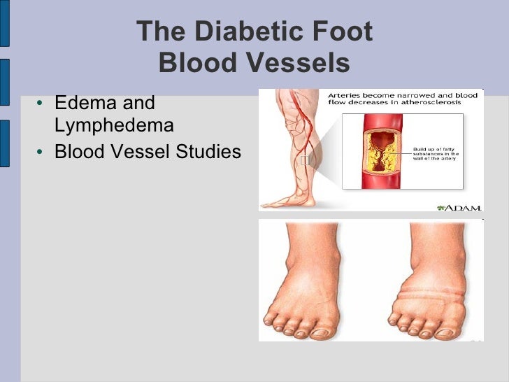 Limb Loss Presentation