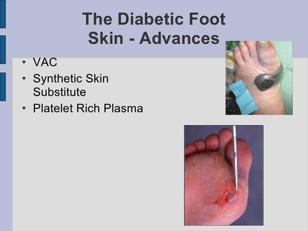 Limb Loss Presentation