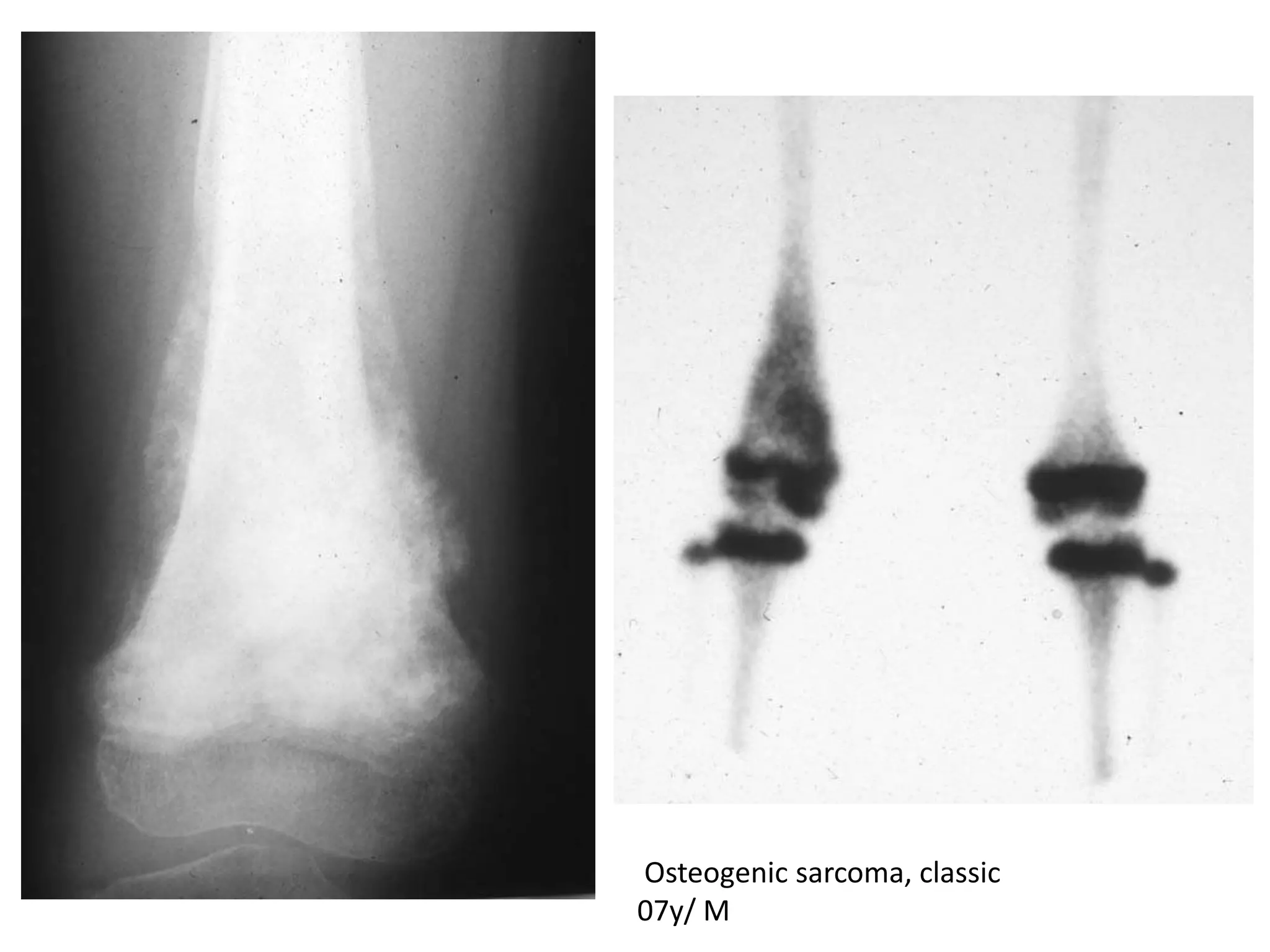 Osteogenic sarcoma, classic
07y/ M
 