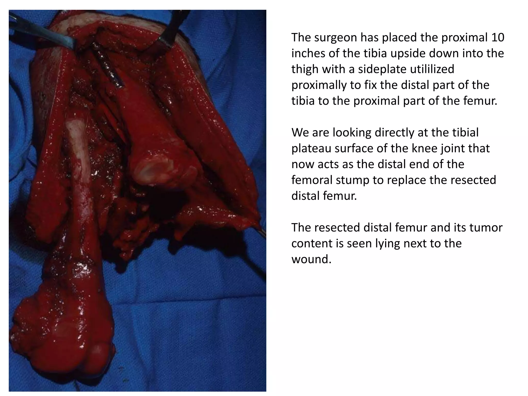 The surgeon has placed the proximal 10
inches of the tibia upside down into the
thigh with a sideplate utililized
proximally to fix the distal part of the
tibia to the proximal part of the femur.

We are looking directly at the tibial
plateau surface of the knee joint that
now acts as the distal end of the
femoral stump to replace the resected
distal femur.

The resected distal femur and its tumor
content is seen lying next to the
wound.
 