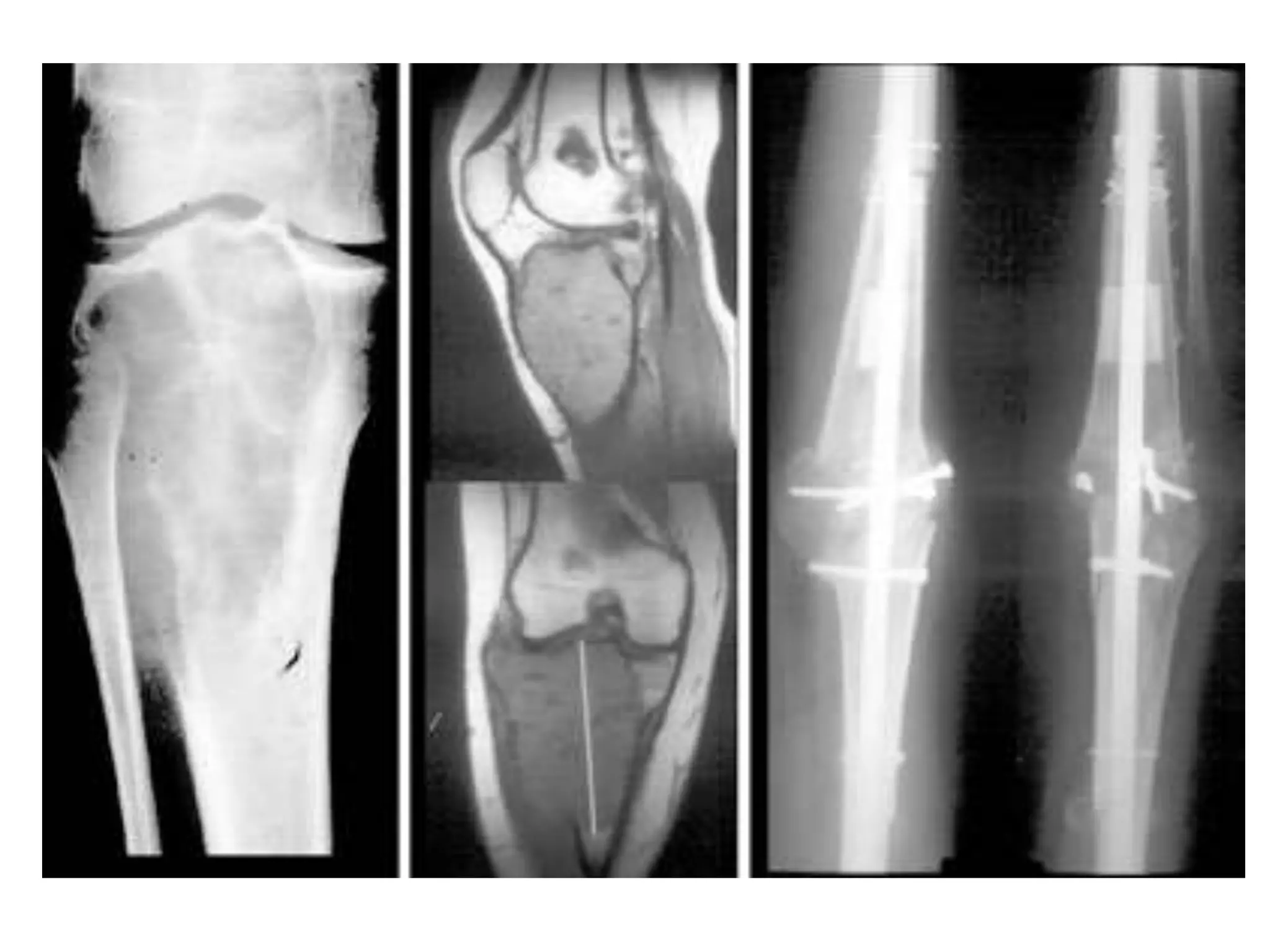 EXTERNAL FIXATOR
                INTRAMEDULLARY NAIL
                      BONE GRAFTS
                   INTERNAL FIXATION




Dual fibular autografts
 