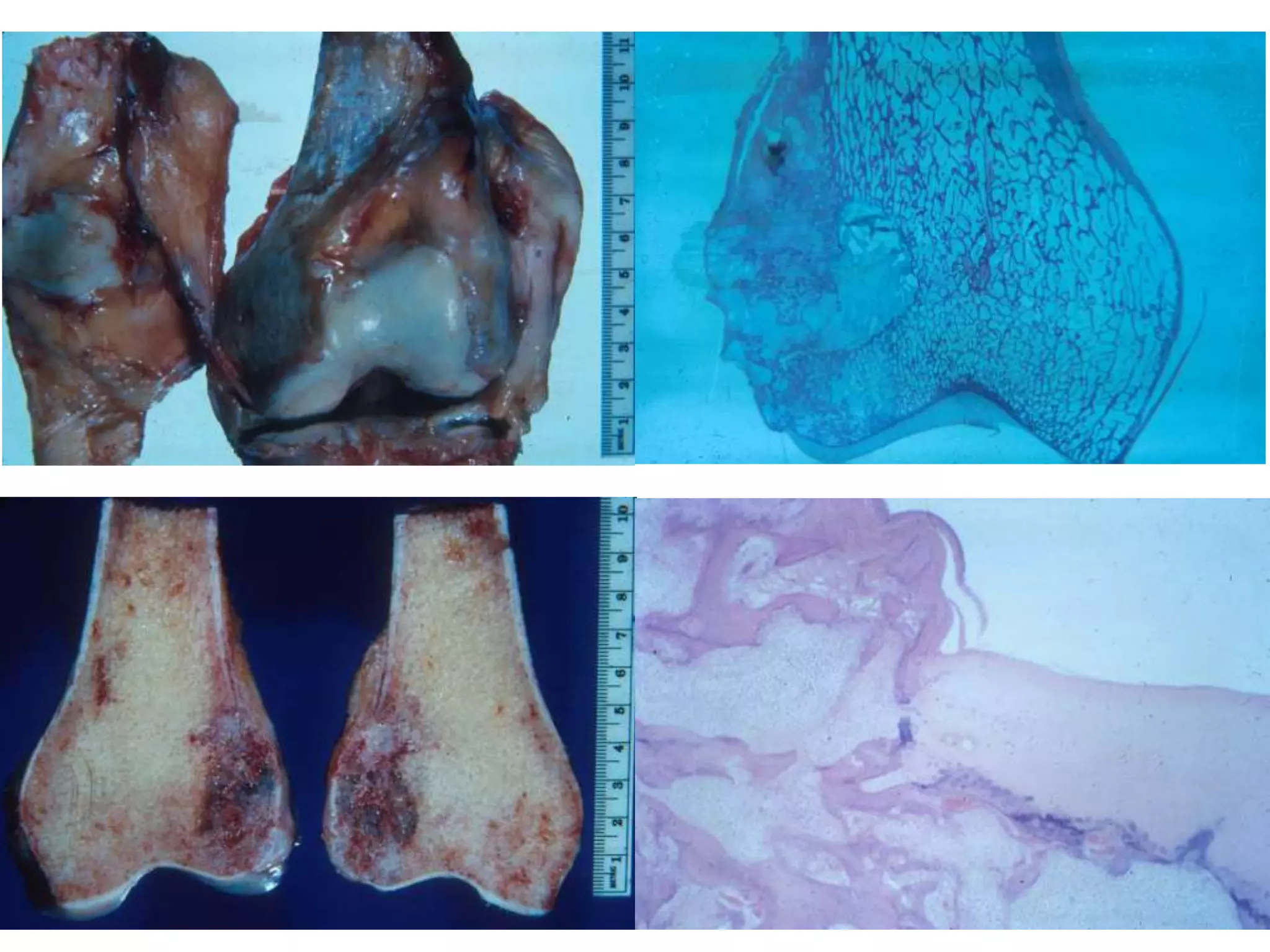 Chondrosarcoma, primary central -
Distal femur
 