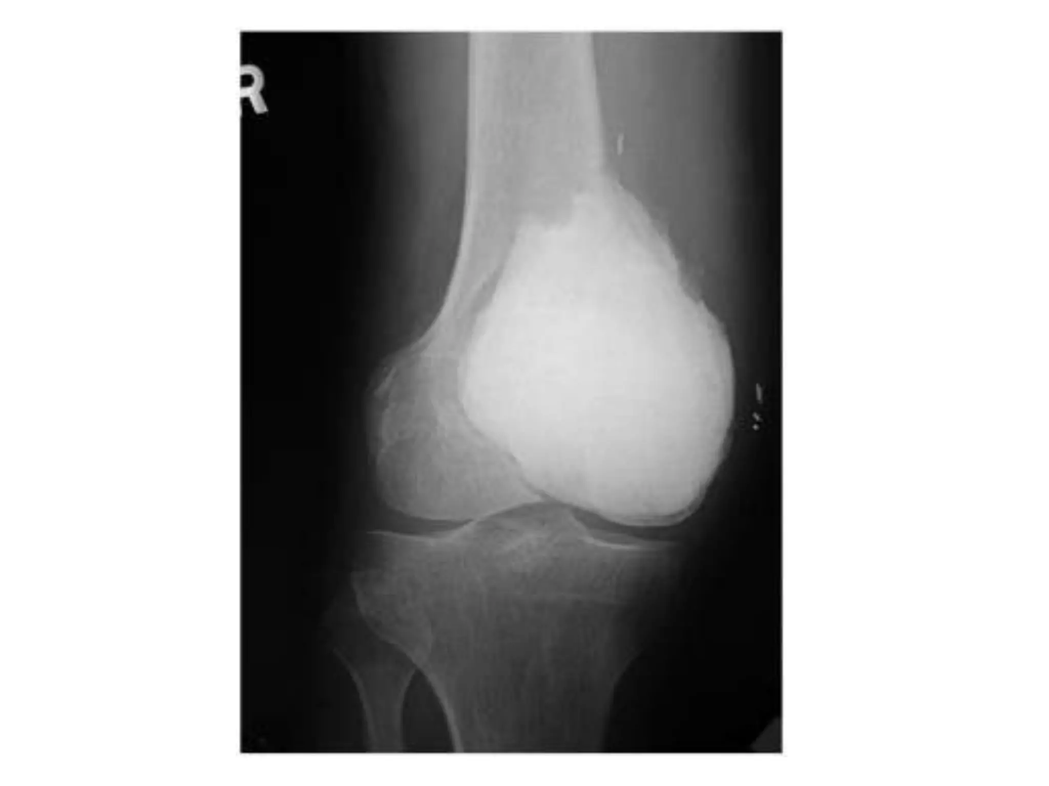 LIMB SALVAGE


RESECTION + RECONSTRUCTION
       BONE CEMENT
 