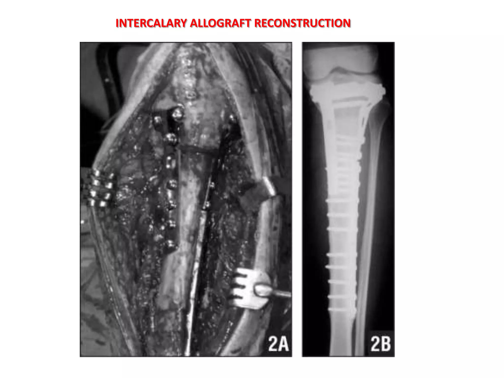 LIMB SALVAGE


RESECTION + RECONSTRUCTION
        ALLOGRAFT
 