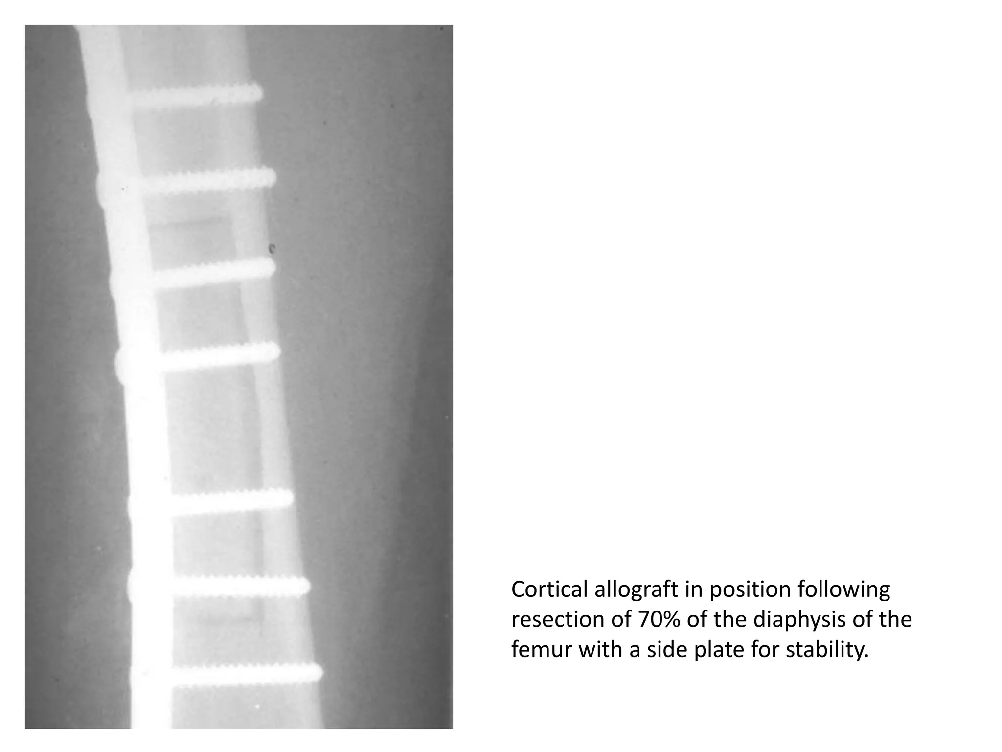 A neoplastic osteoid formation
by osteoblastic cells that have
the appearance of an low grade
osteosarcoma.
 