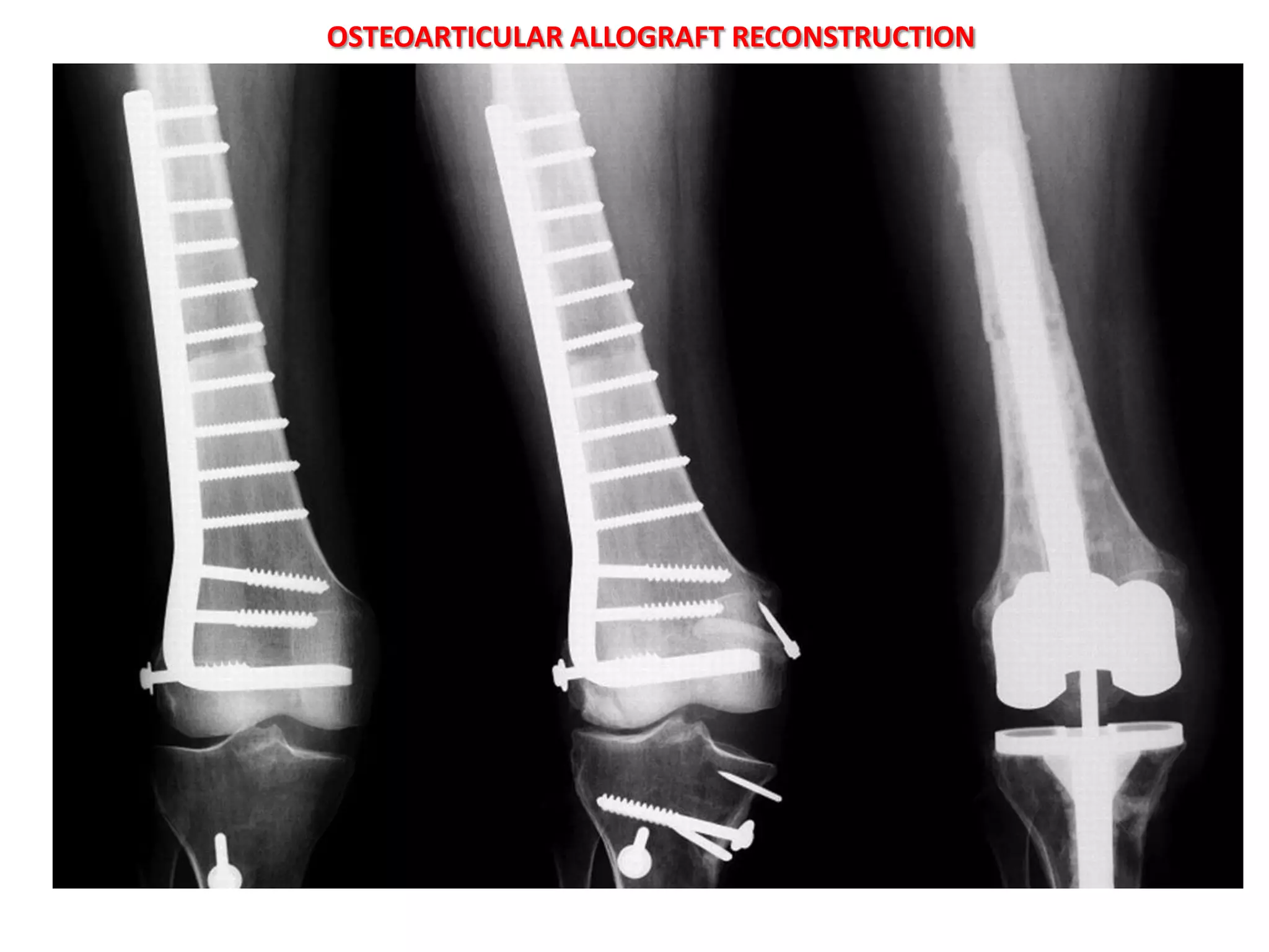 Wide resection of the distal portion of the
 humeral diaphysis was carried out, leaving the
 elbow joint intact.

 The defect was reconstructed with an allograft
 fixed into postion with a recon plate.


ADVANTAGES
Availability in all sizes and shapes

Progressive incorporation into host bone

Conventional arthroplasty instead of custom made
prosthesis

Attachment sites available for resected muscles and
joint stabilisers – better function

No donor site morbidity

Failed allograft – further options available
 