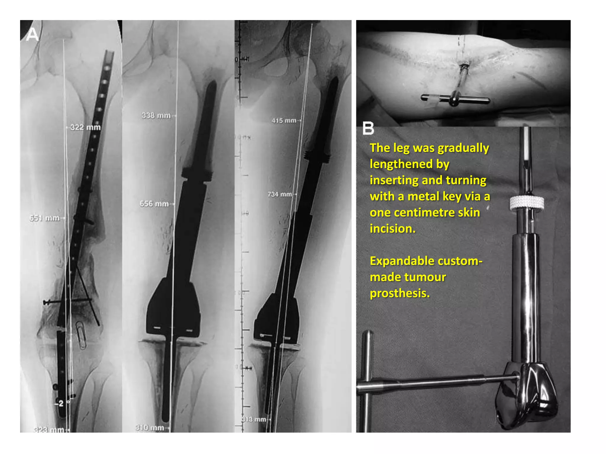 PROSTHETIC RECONSTRUCTION

• Advantage – earliest mobilisation and weight bearing

• 10-year survival of modular prosthesis for
   –   Distal femur – 90%.
   –   Proximal humerus – 98%.
   –   Proximal femur – 100%.
   –   Proximal tibia – 78%.
 