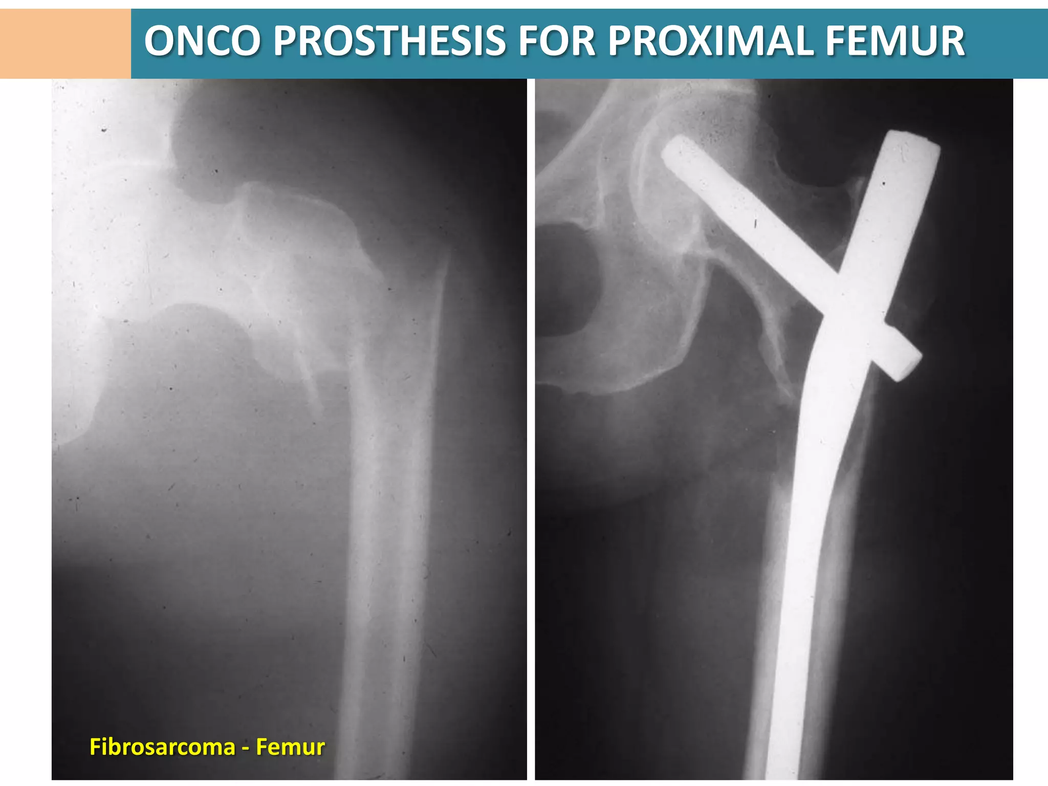 ONCO PROSTHESIS FOR PROXIMAL FEMUR




Fibrosarcoma - Femur
 