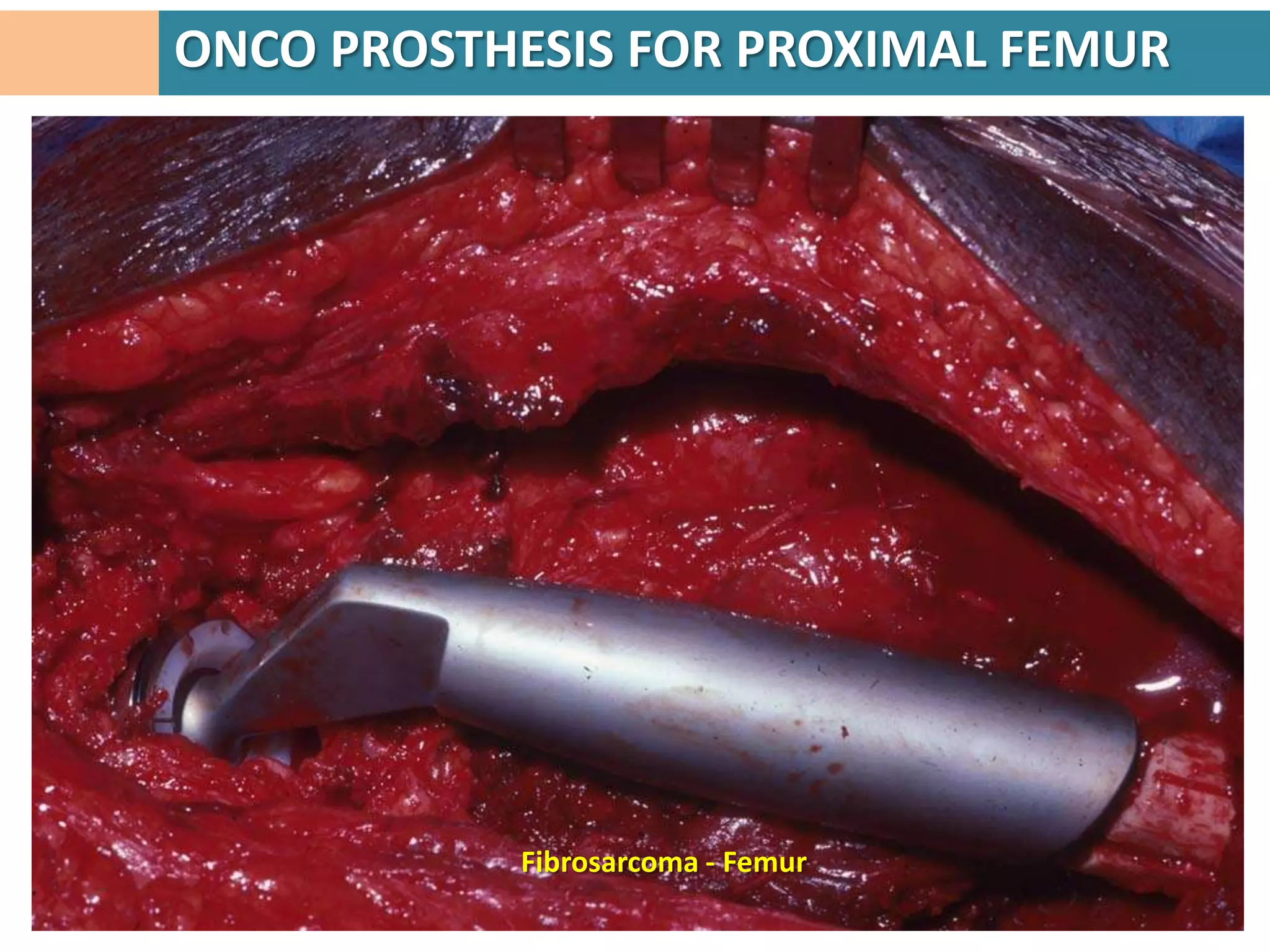 ONCO PROSTHESIS FOR PROXIMAL FEMUR




           Fibrosarcoma - Femur
 