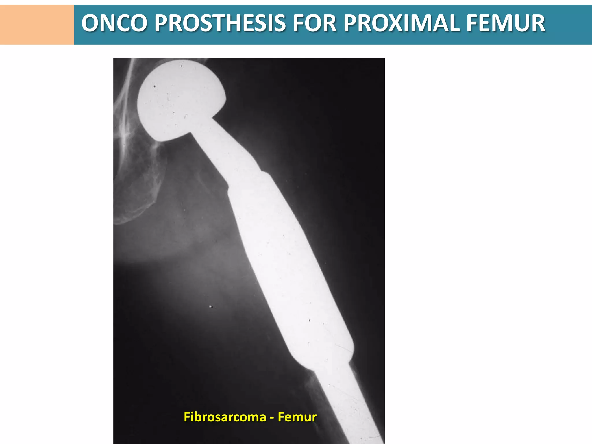 ONCO PROSTHESIS FOR PROXIMAL FEMUR




       Fibrosarcoma - Femur
 
