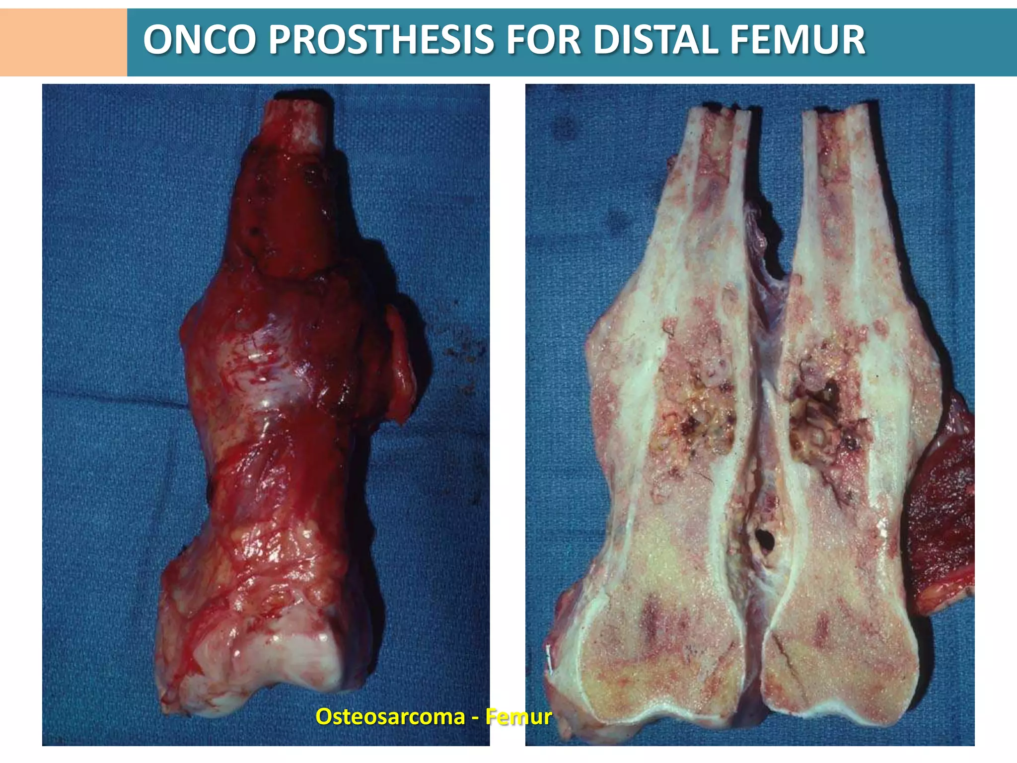 ONCO PROSTHESIS FOR DISTAL FEMUR




       Osteosarcoma - Femur
 
