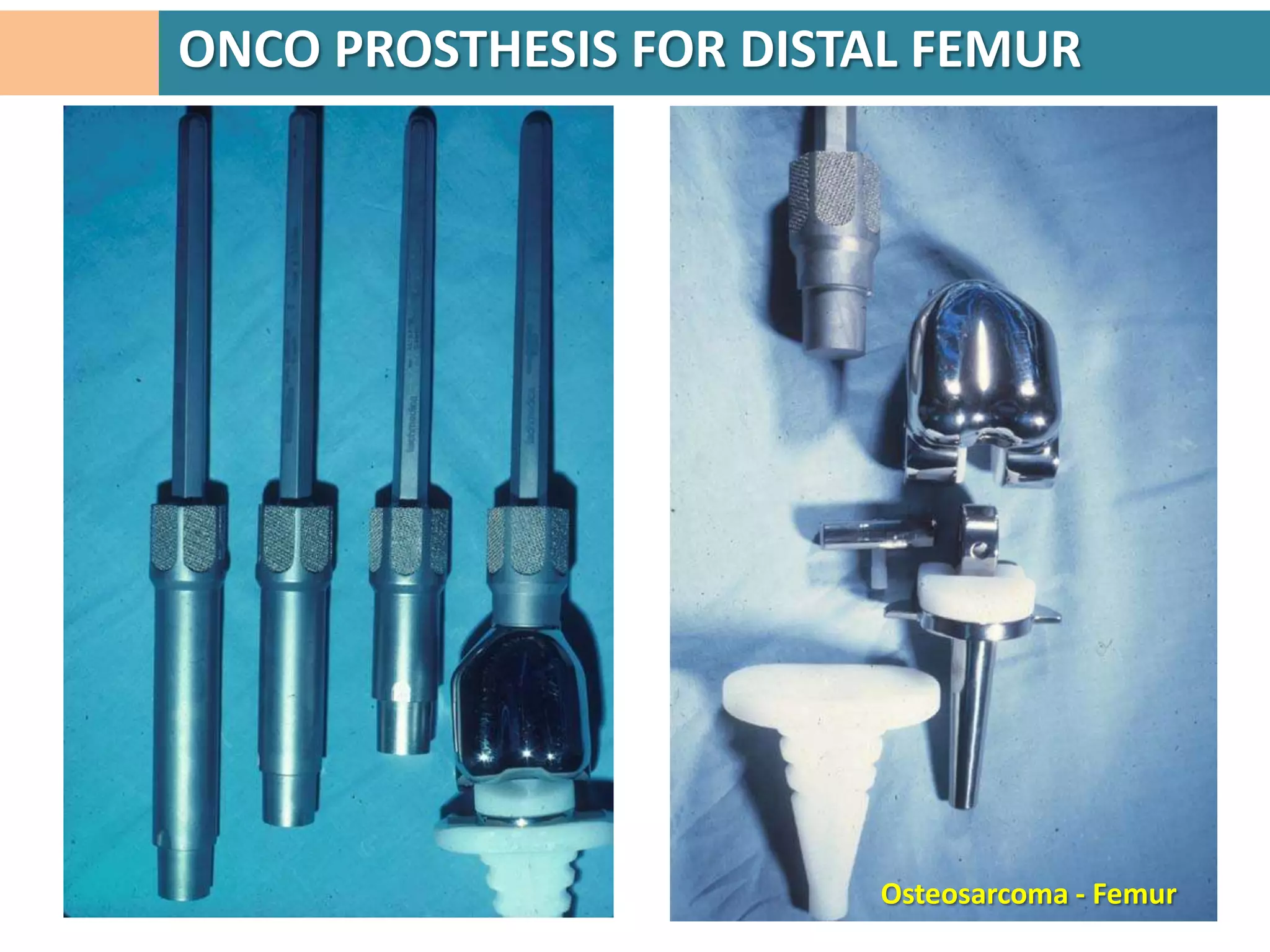 ONCO PROSTHESIS FOR DISTAL FEMUR




                        Osteosarcoma - Femur
 