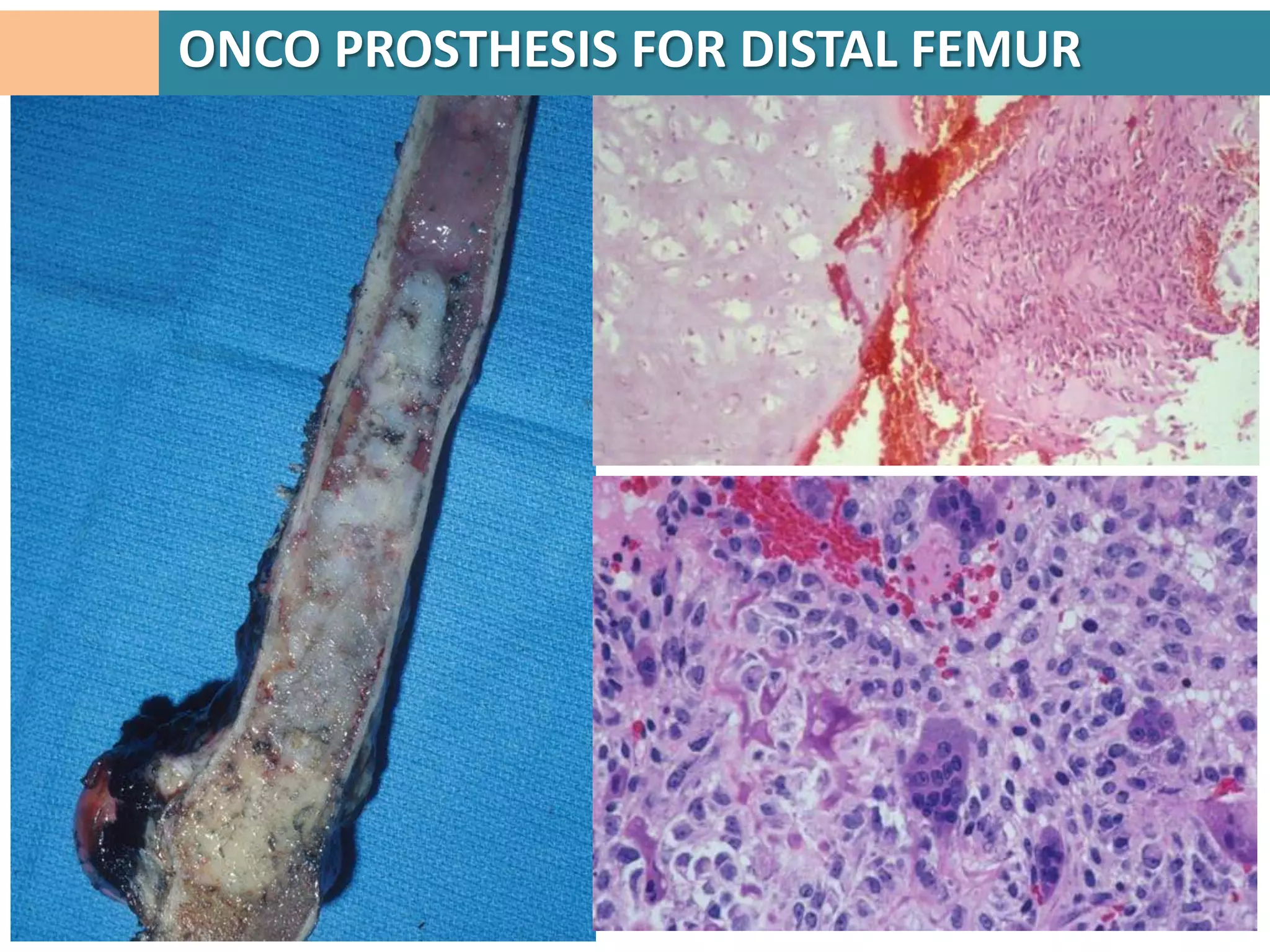 ONCO PROSTHESIS FOR DISTAL FEMUR
 