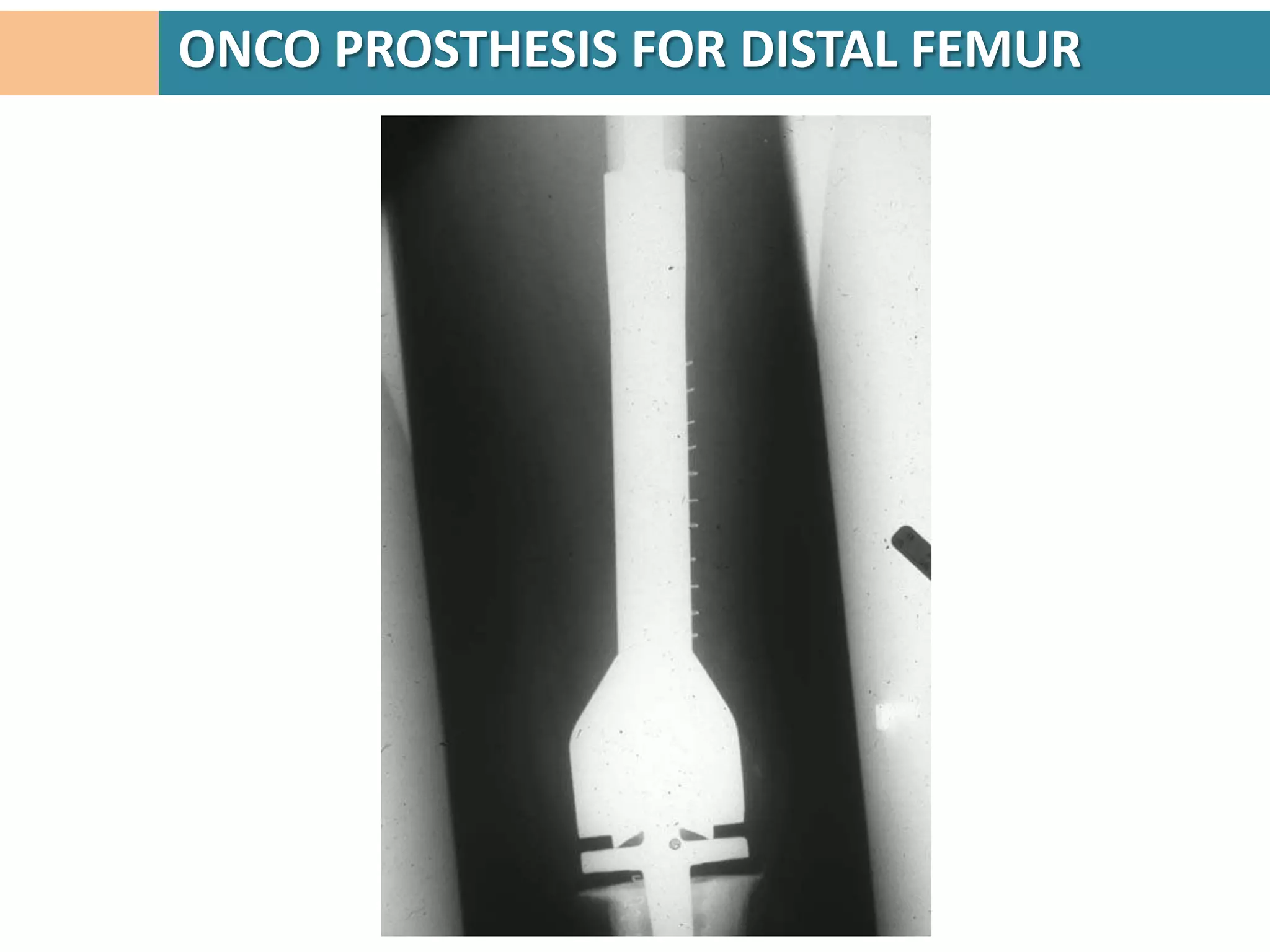 ONCO PROSTHESIS FOR DISTAL FEMUR
 