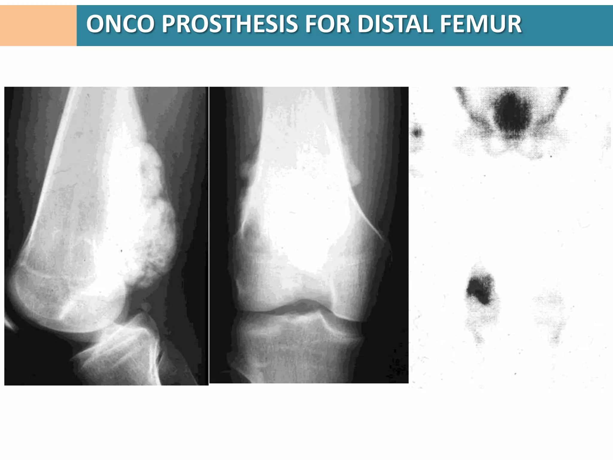 ONCO PROSTHESIS FOR DISTAL FEMUR




                 TMH-NICE
                 (New Indigenous Customised
                 Endoprosthesis)joint
 