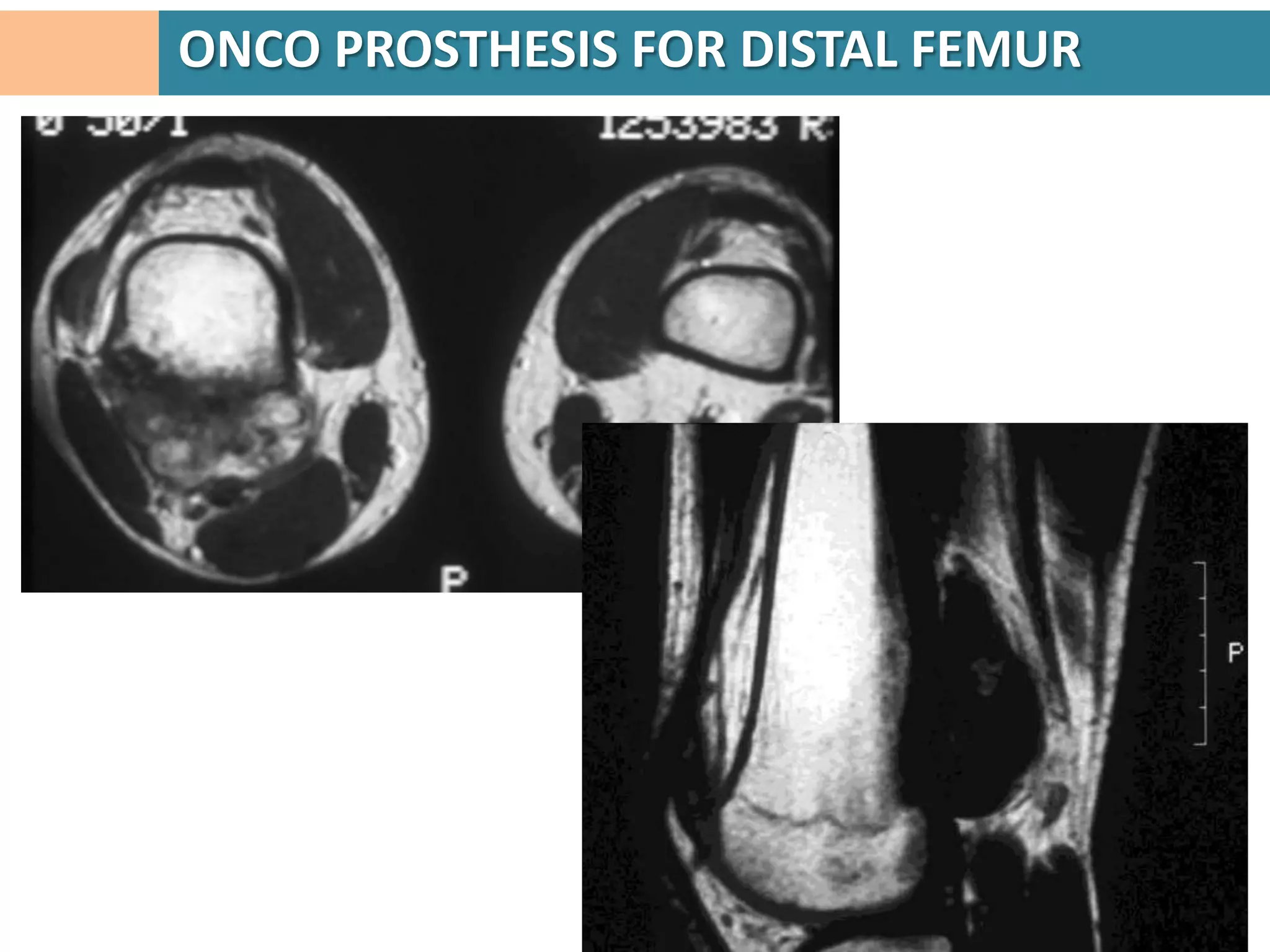 ONCO PROSTHESIS FOR PROXIMAL HUMERUS
 