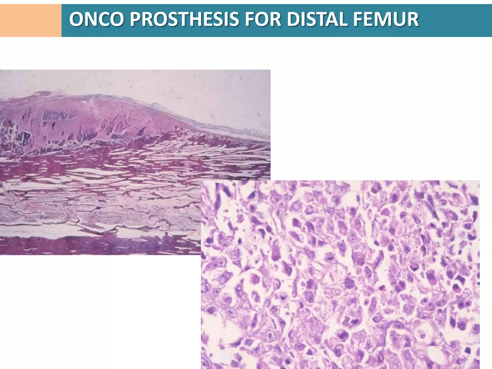 Osteosarcoma of scapula. Unconstrained total scapular prosthesis with cemented
                  humeral component used for limb salvage.
 