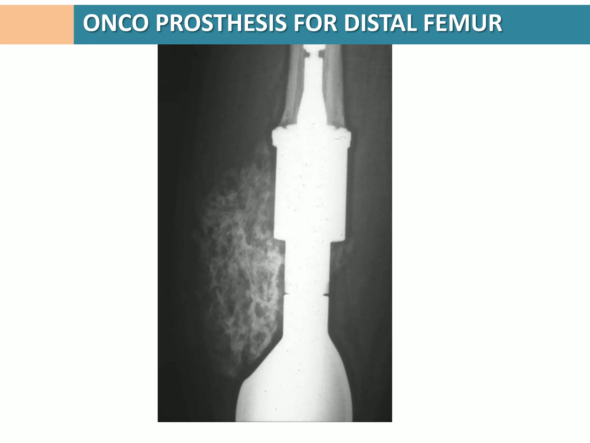 LIMB SALVAGE


  RESECTION + RECONSTRUCTION
ALLOGRAFT PROSTHESIS COMPOSITE

     Attachment sites available for resected
   muscles and joint stabilisers – better function
 