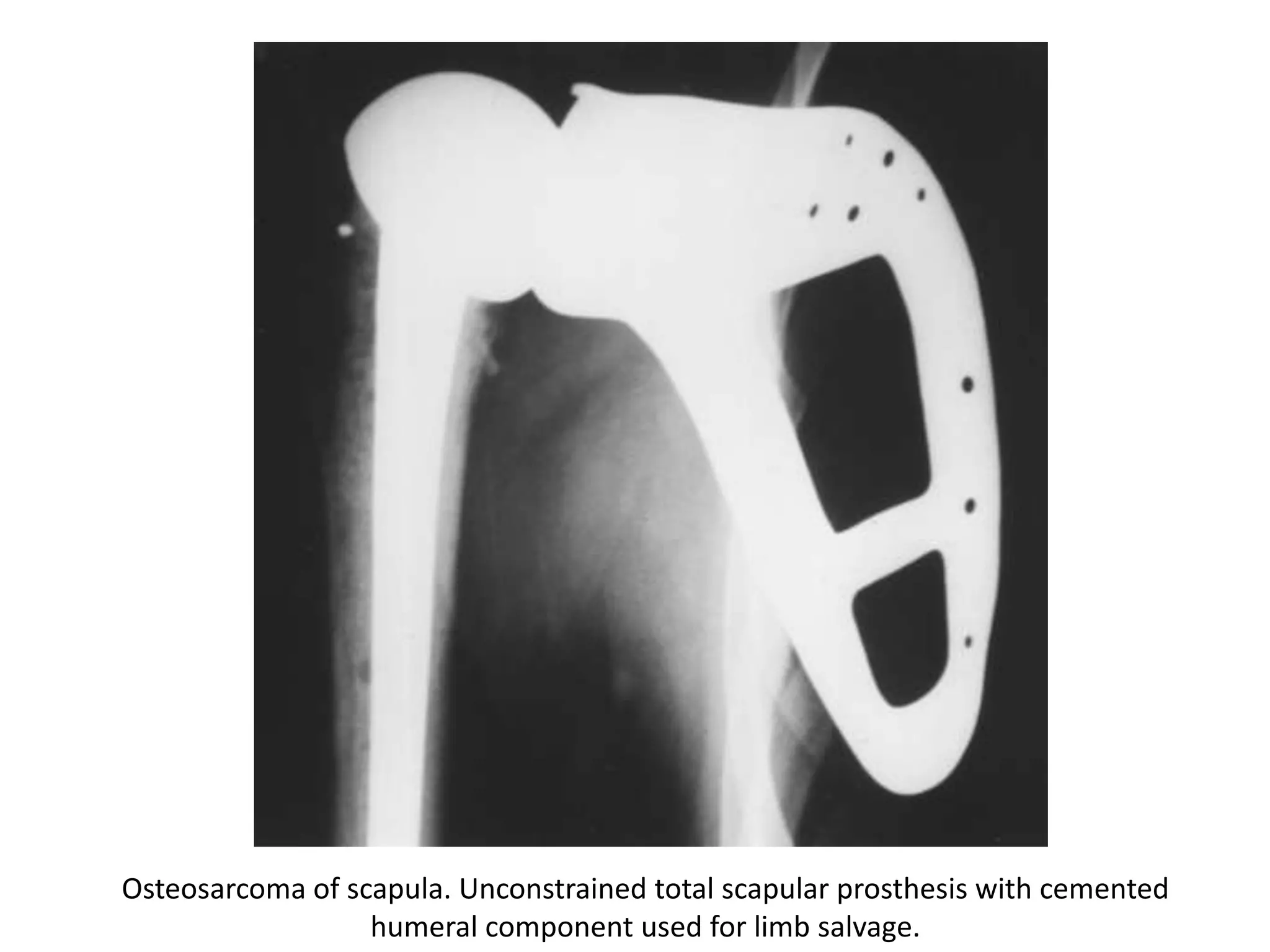 Combined allograft and
cemented Neer prosthesis
 