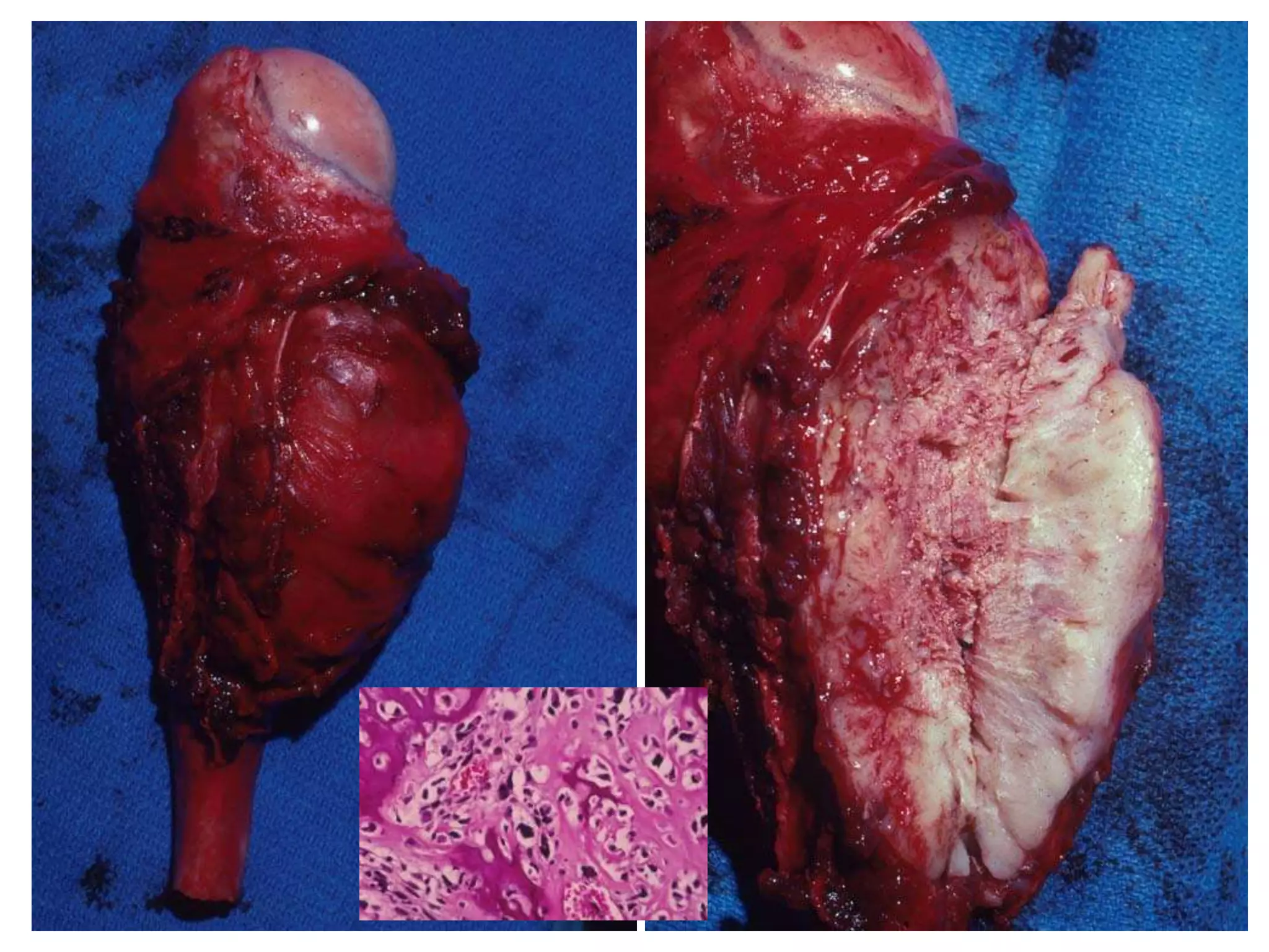 Osteogenic sarcoma, periosteal -
Proximal tibia
 