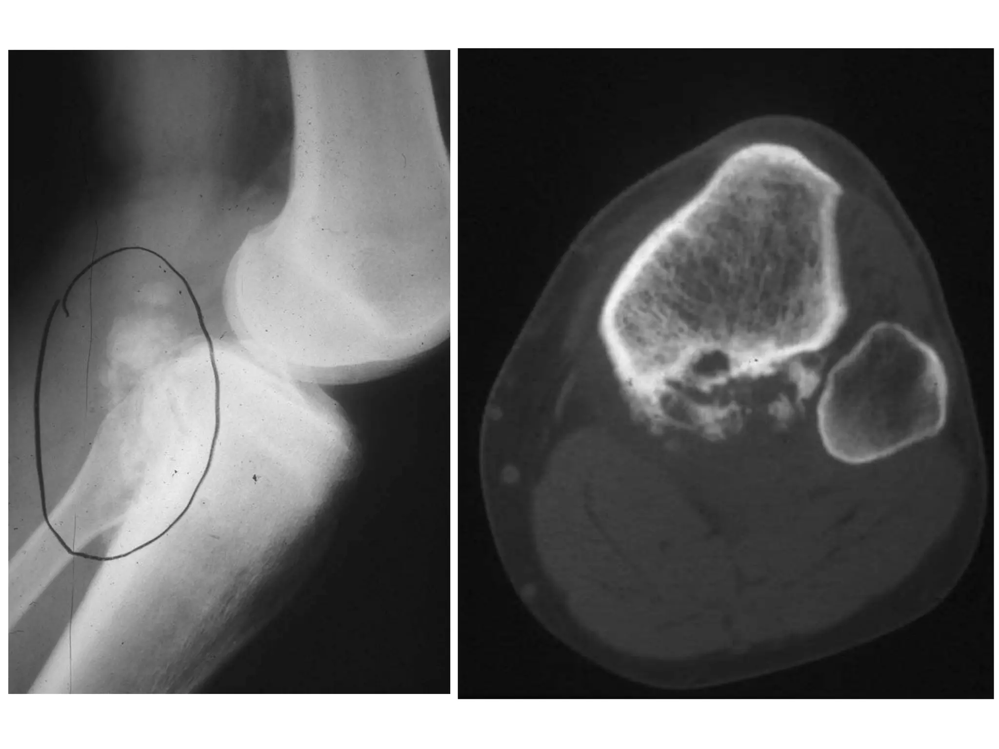 Restoring bone stock

Preventing loosening by increasing interface
surface between prosthesis and bone

Limiting proximal bone resorption
 