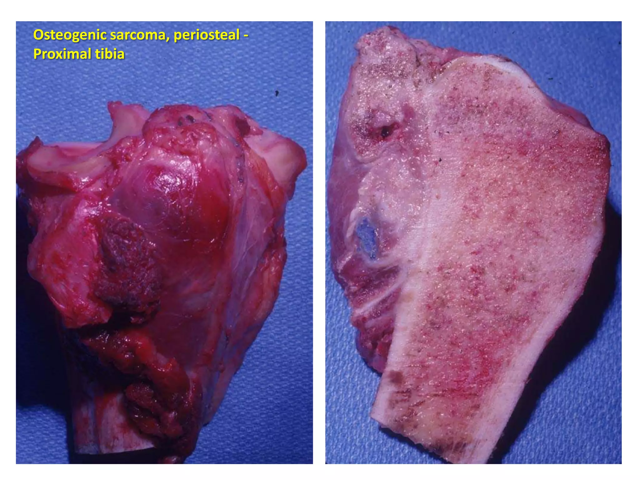 Malignant fibrous histiocytoma - Proximal
humerus
 