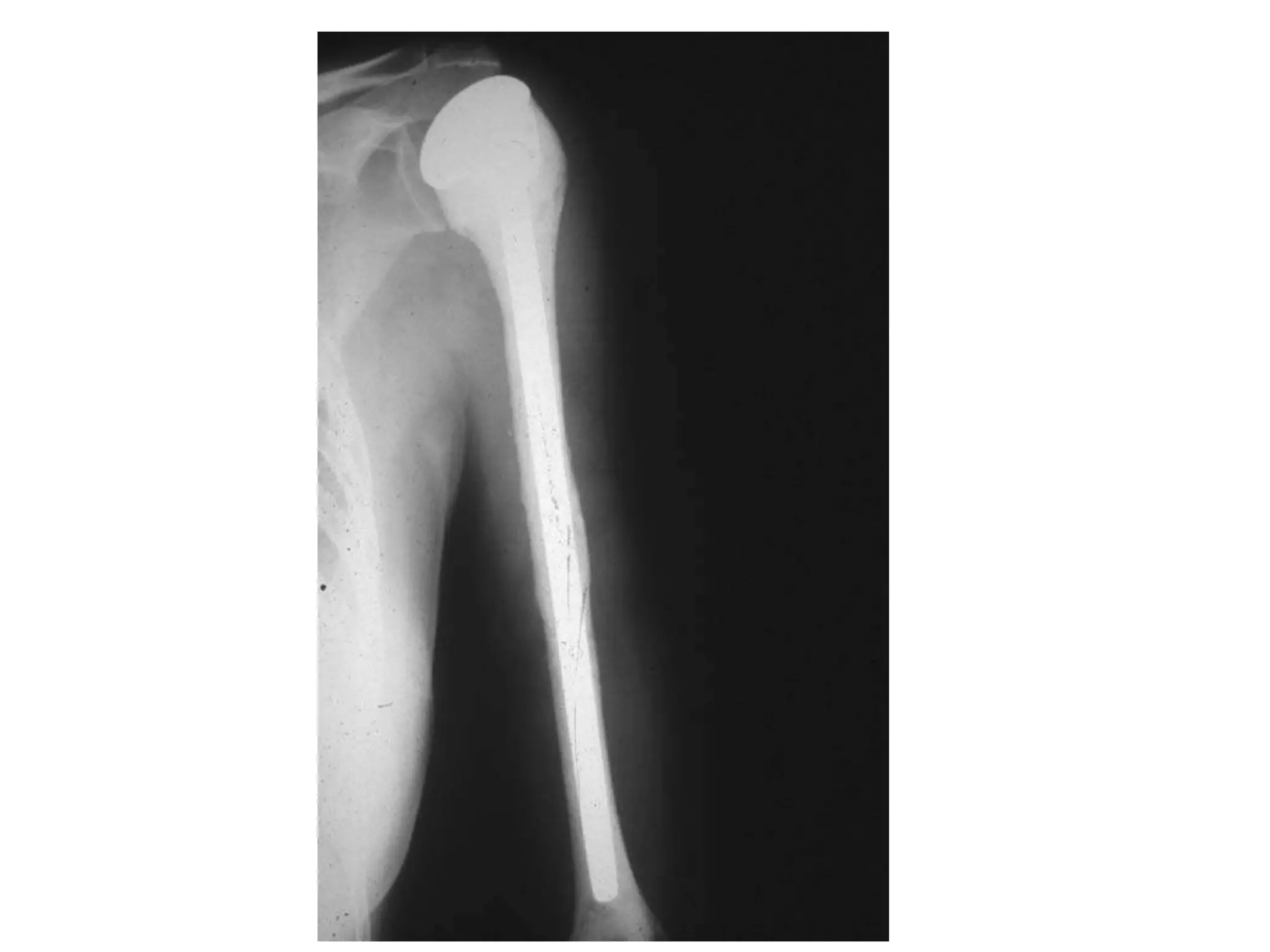 Acetabulum following the resection
showing the hyperemic changes in the
acetabular synovial tissues, a response
to the antigen stimulation of the
nearby tumor in the upper femur.
There is no crossover into the
acetabular structures preventing the
need for a more aggressive internal
hemipelvectomy reconstruction.
 