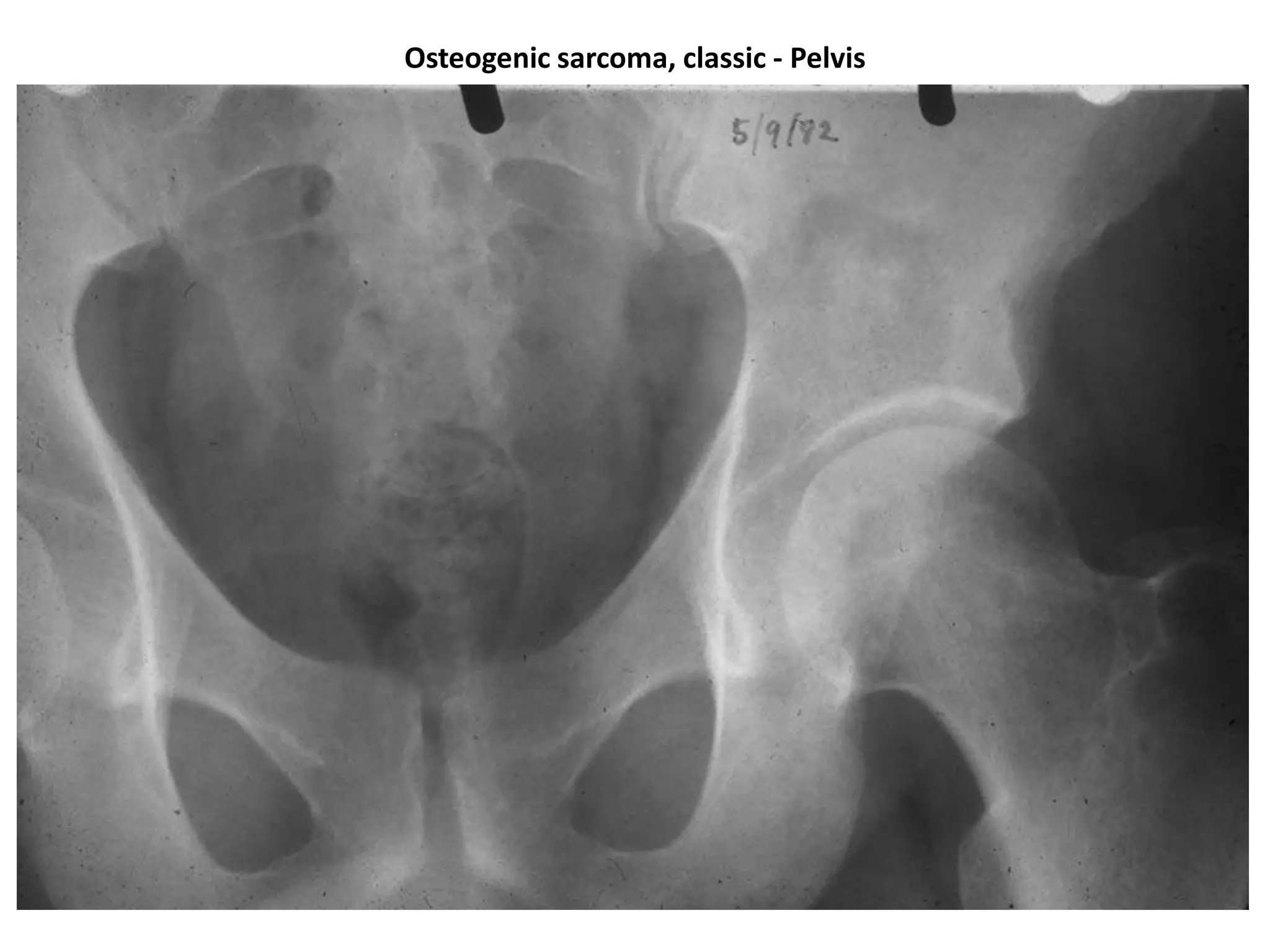 Ewing's sarcoma – Femur With Pathological fracture from biopsy site
 