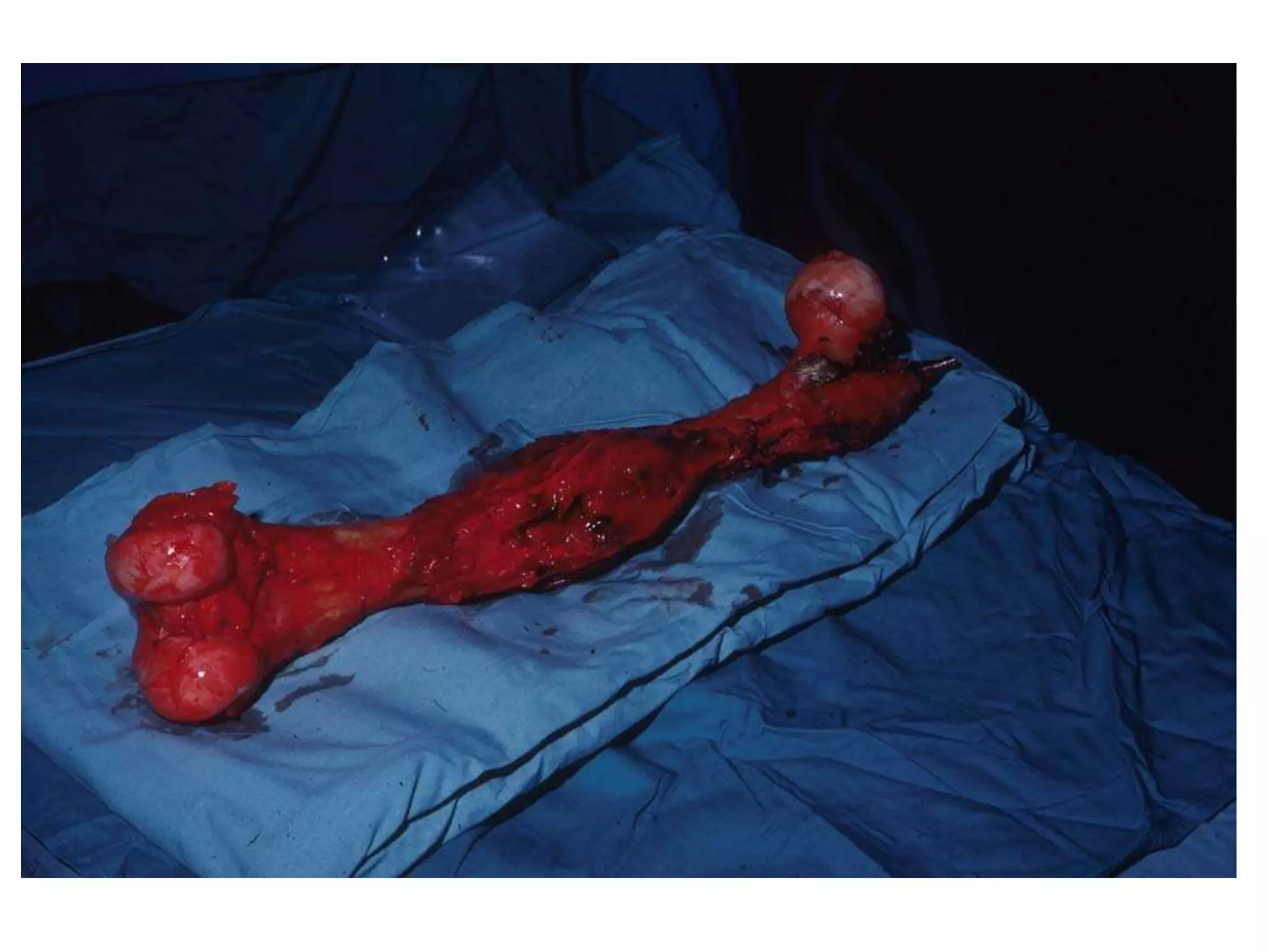 ROTATIONPLASTY

• Group AI— Distal Femur.
 