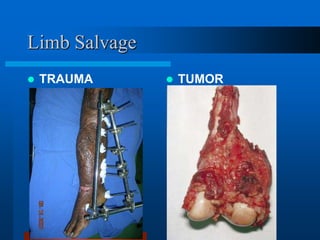 Limb Salvage
 TRAUMA  TUMOR
 
