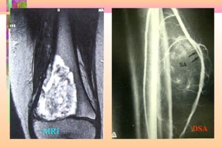 Limb salvage of lower extremity | PPT