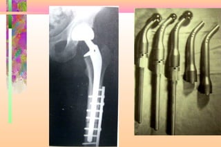 Limb salvage of lower extremity | PPT