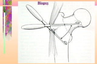 Limb salvage of lower extremity | PPT