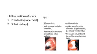• Inflammations of sclera
1. Episcleritis (superficial)
2. Scleritis(deep)
 