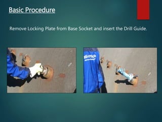 Basic Procedure
Remove Locking Plate from Base Socket and insert the Drill Guide.
 