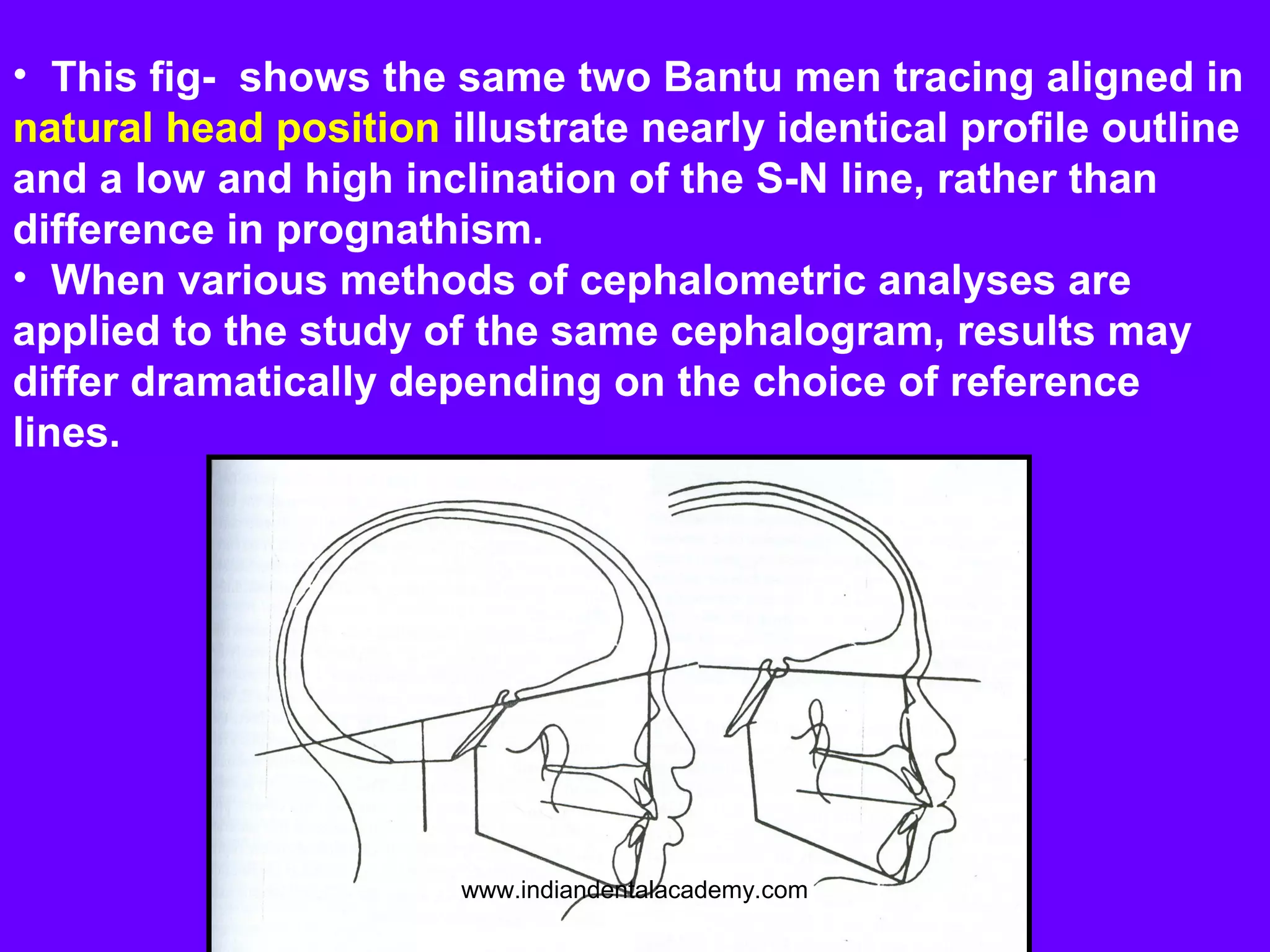 • This fig- shows the same two Bantu men tracing aligned in
natural head position illustrate nearly identical profile outline
and a low and high inclination of the S-N line, rather than
difference in prognathism.
• When various methods of cephalometric analyses are
applied to the study of the same cephalogram, results may
differ dramatically depending on the choice of reference
lines.
www.indiandentalacademy.com
 