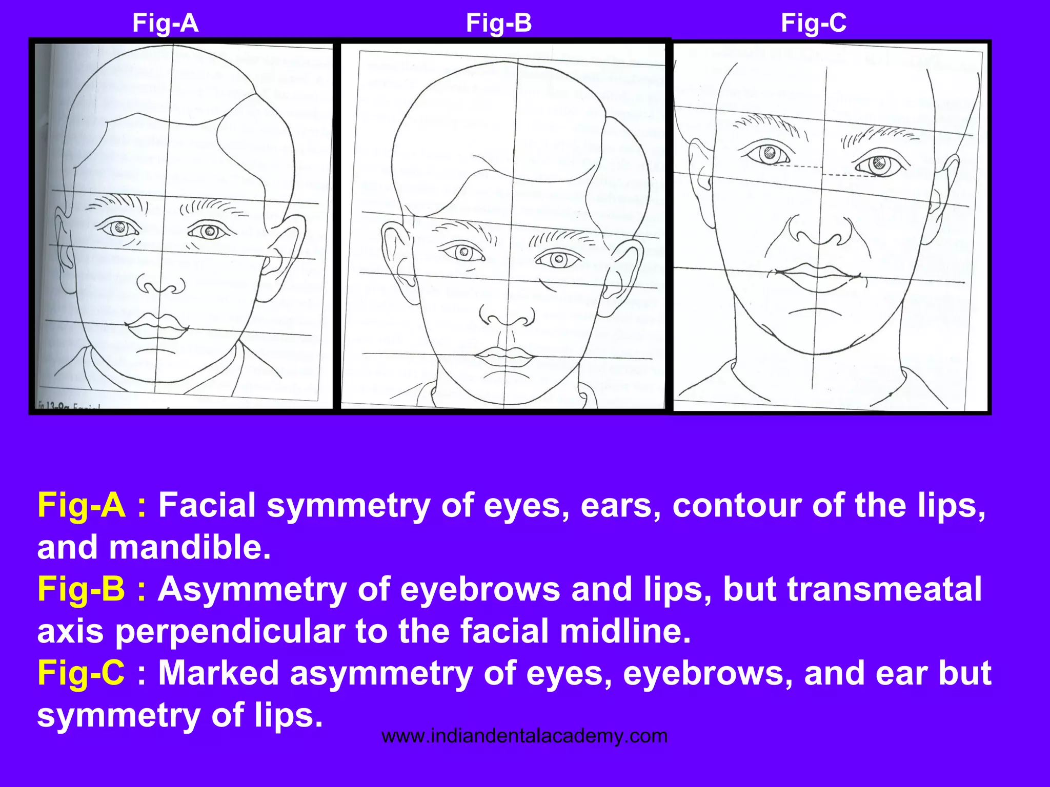 Fig-A Fig-B Fig-C
Fig-A : Facial symmetry of eyes, ears, contour of the lips,
and mandible.
Fig-B : Asymmetry of eyebrows and lips, but transmeatal
axis perpendicular to the facial midline.
Fig-C : Marked asymmetry of eyes, eyebrows, and ear but
symmetry of lips. www.indiandentalacademy.com
 
