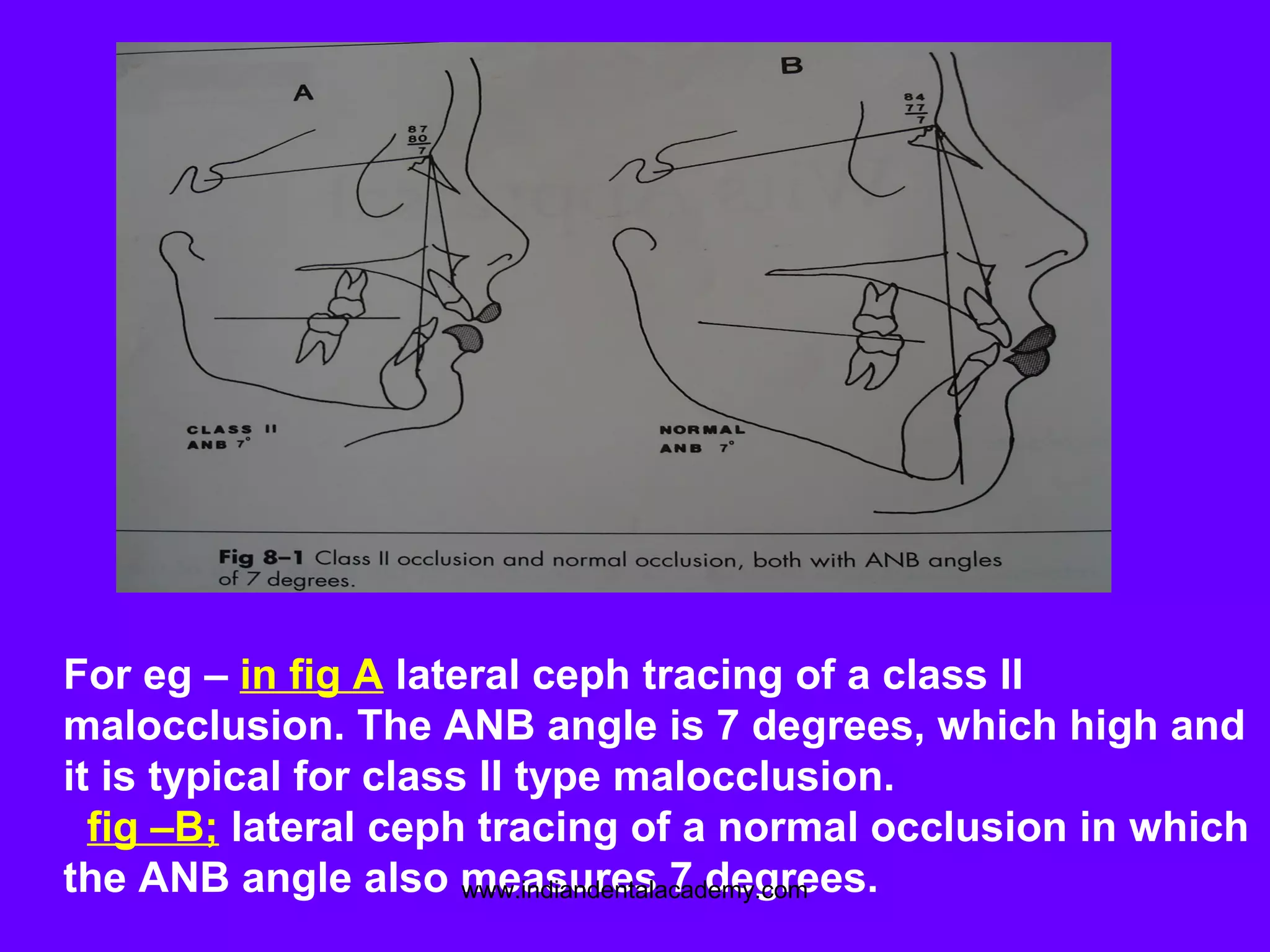 For eg – in fig A lateral ceph tracing of a class II
malocclusion. The ANB angle is 7 degrees, which high and
it is typical for class II type malocclusion.
fig –B; lateral ceph tracing of a normal occlusion in which
the ANB angle also measures 7 degrees.www.indiandentalacademy.com
 
