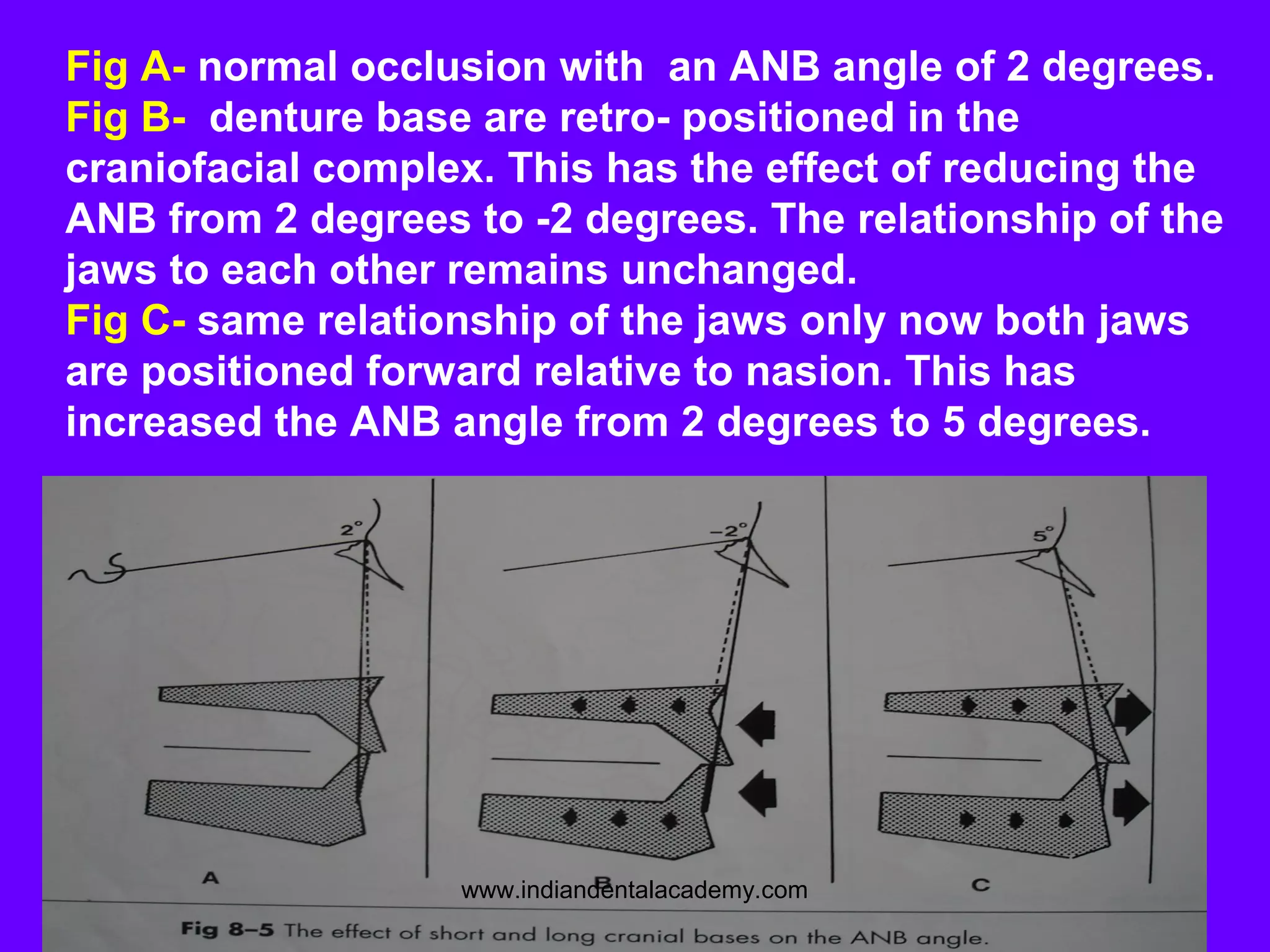 Fig A- normal occlusion with an ANB angle of 2 degrees.
Fig B- denture base are retro- positioned in the
craniofacial complex. This has the effect of reducing the
ANB from 2 degrees to -2 degrees. The relationship of the
jaws to each other remains unchanged.
Fig C- same relationship of the jaws only now both jaws
are positioned forward relative to nasion. This has
increased the ANB angle from 2 degrees to 5 degrees.
www.indiandentalacademy.com
 