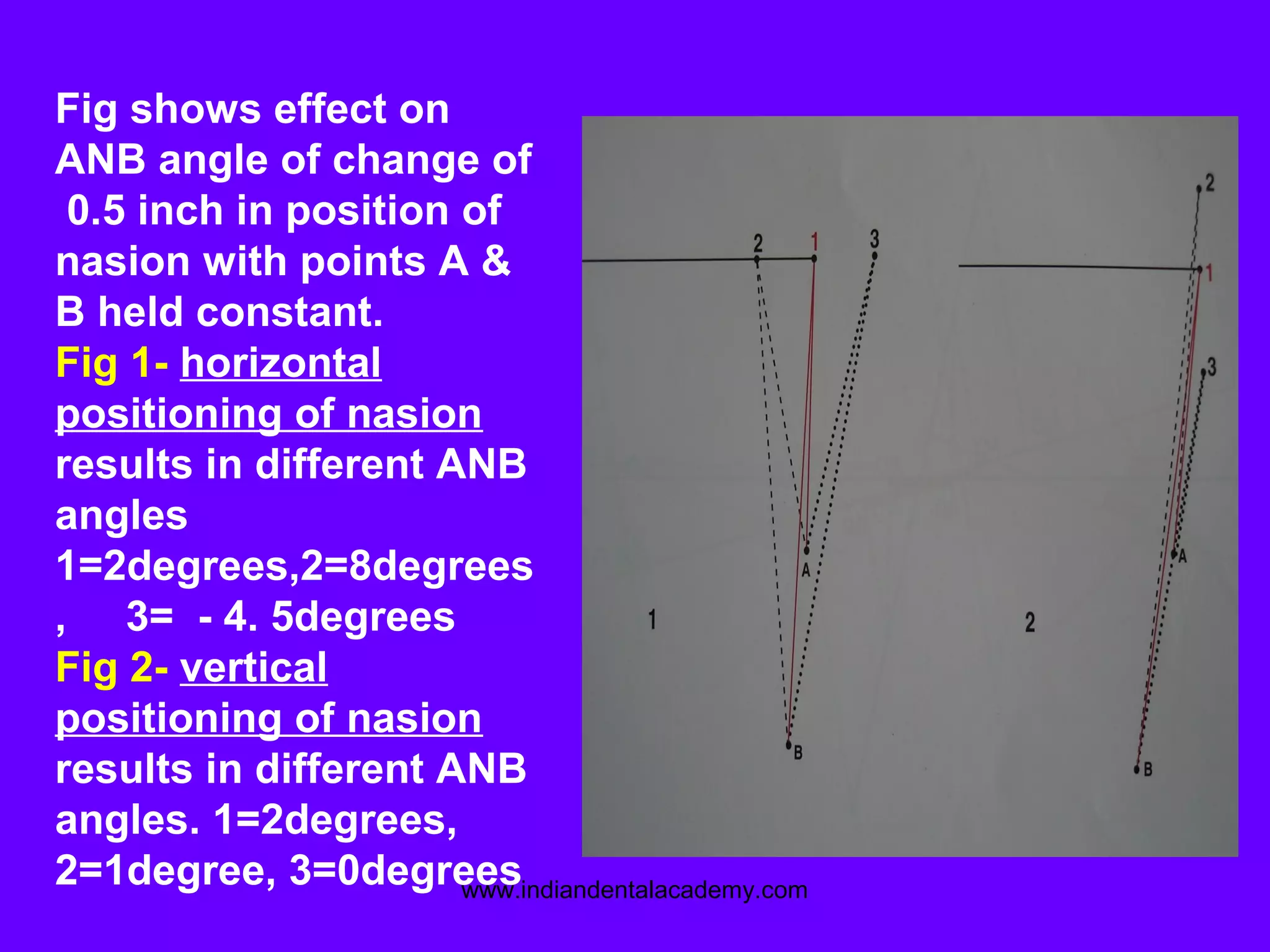 Fig shows effect on
ANB angle of change of
0.5 inch in position of
nasion with points A &
B held constant.
Fig 1- horizontal
positioning of nasion
results in different ANB
angles
1=2degrees,2=8degrees
, 3= - 4. 5degrees
Fig 2- vertical
positioning of nasion
results in different ANB
angles. 1=2degrees,
2=1degree, 3=0degreeswww.indiandentalacademy.com
 